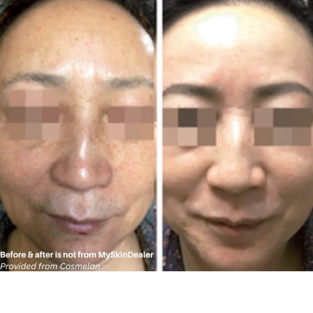 Cosmelan® Peel