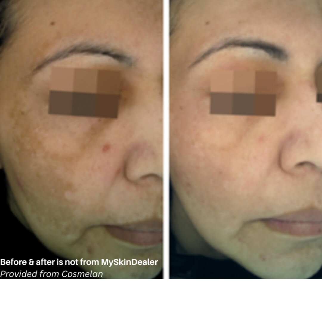 Cosmelan® Peel