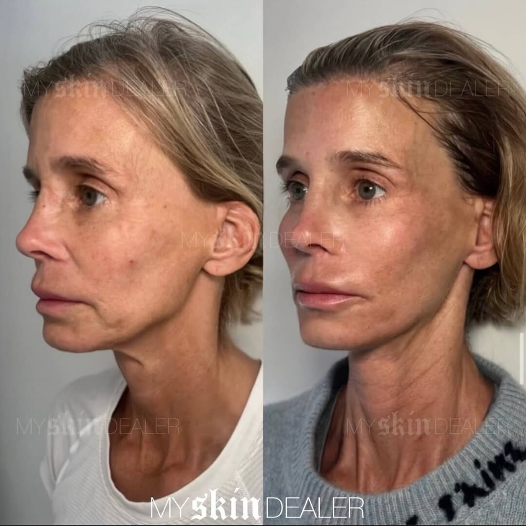 Morpheus Face Boca Raton