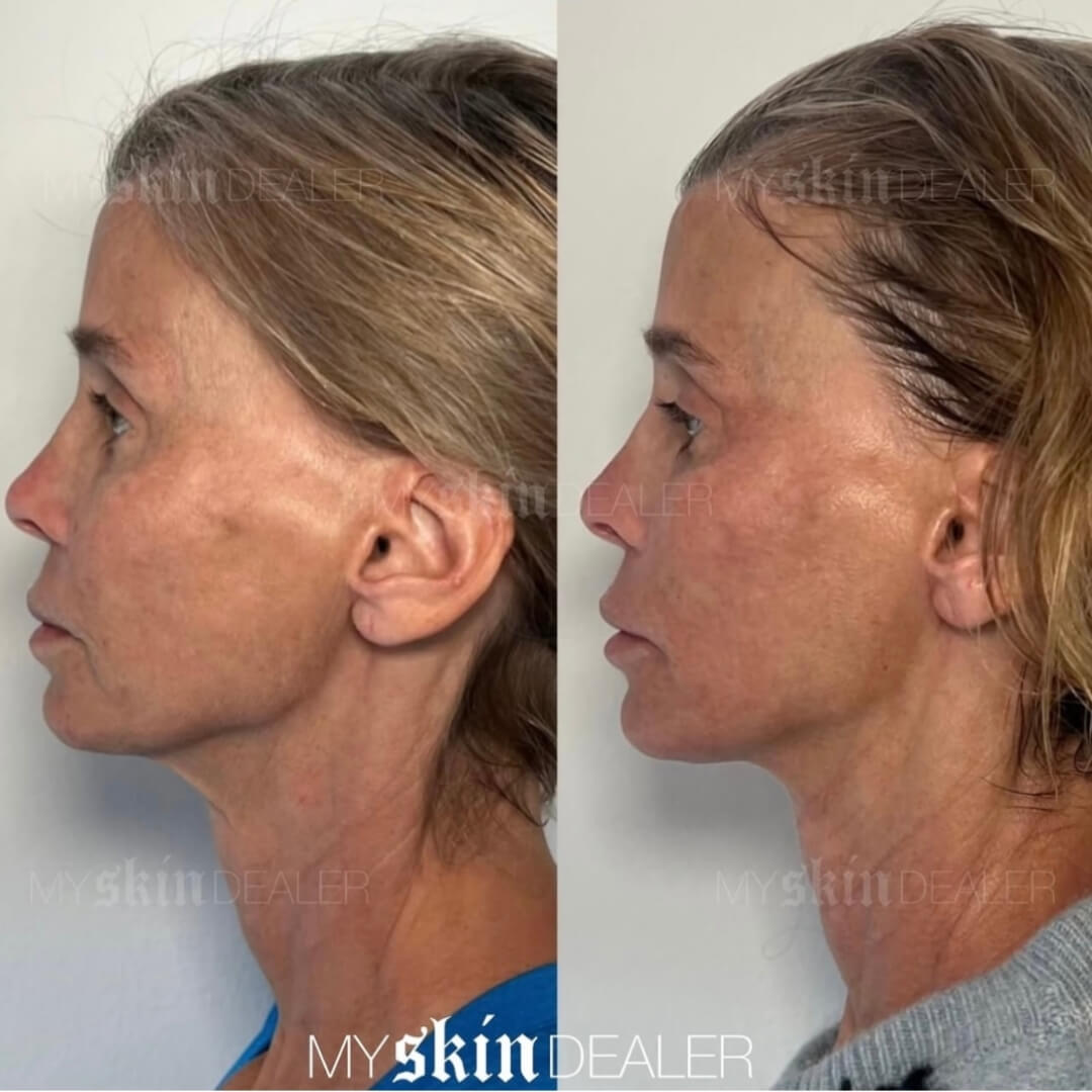 Morpheus Face Boca Raton