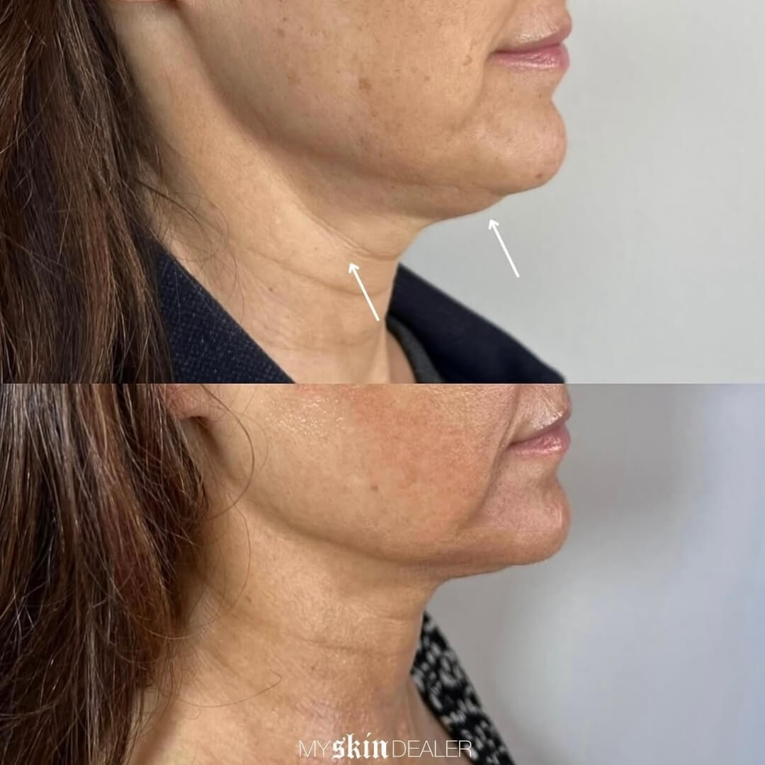 Morpheus Face Boca Raton