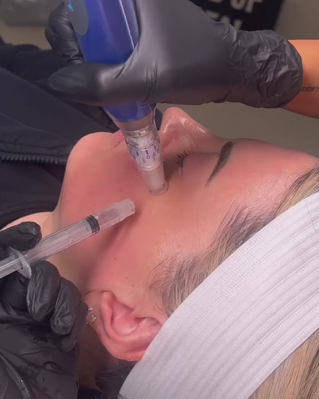 SkinPen® Microneedling