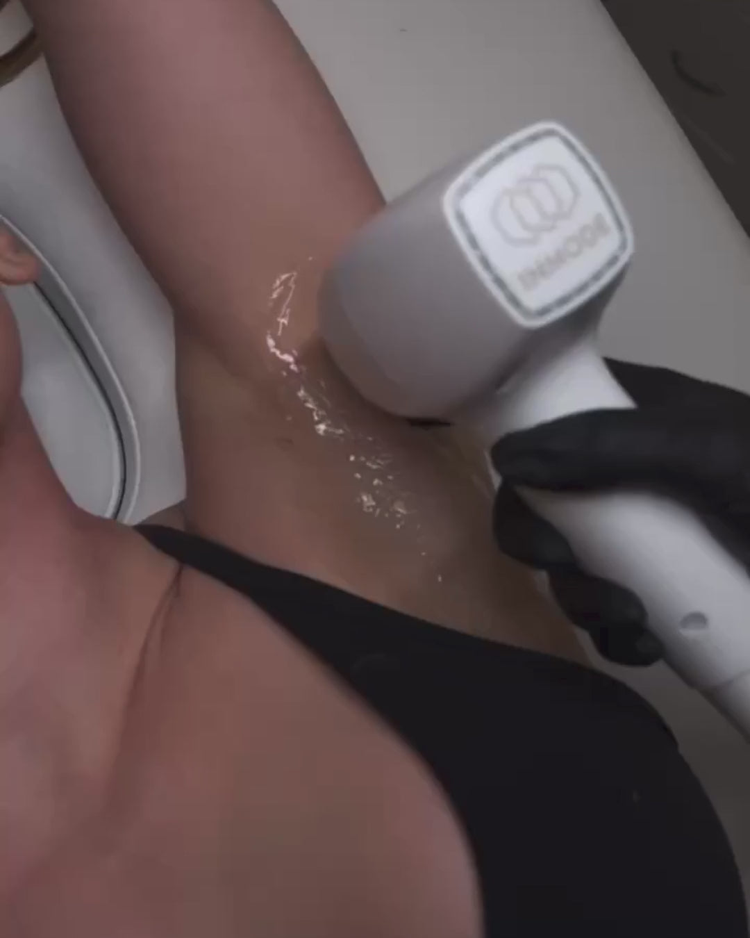 Laser Hair Removal