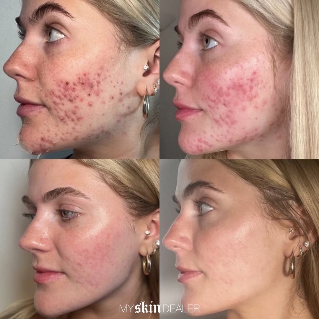 SkinPen® Microneedling
