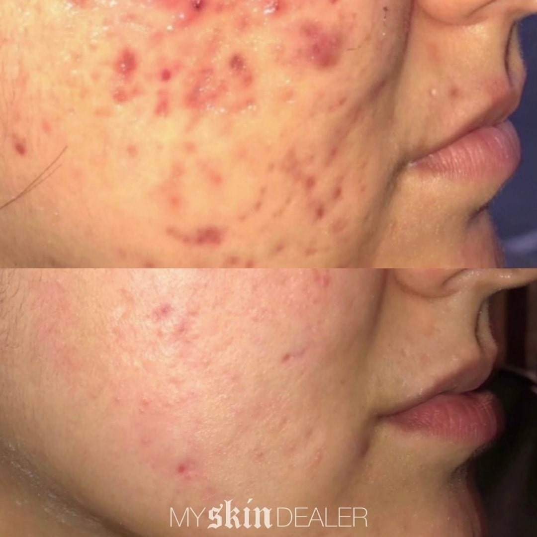 SkinPen® Microneedling