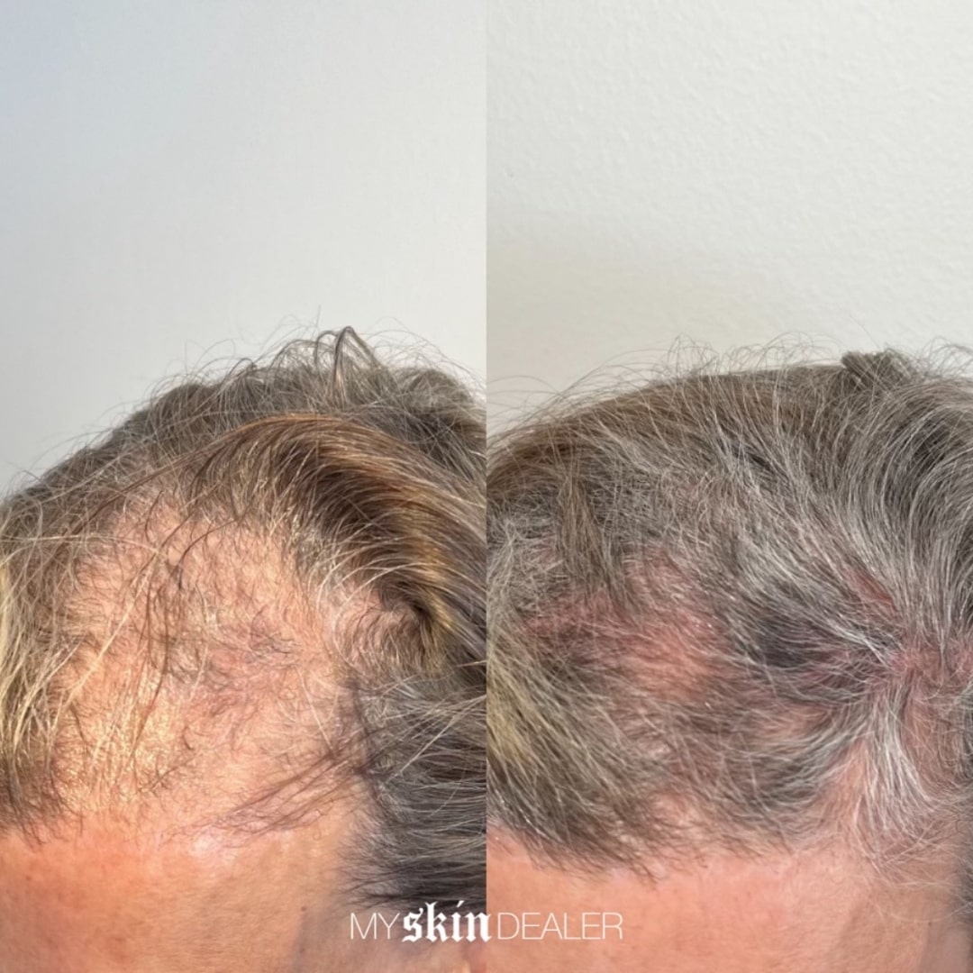 SkinPen® Microneedling