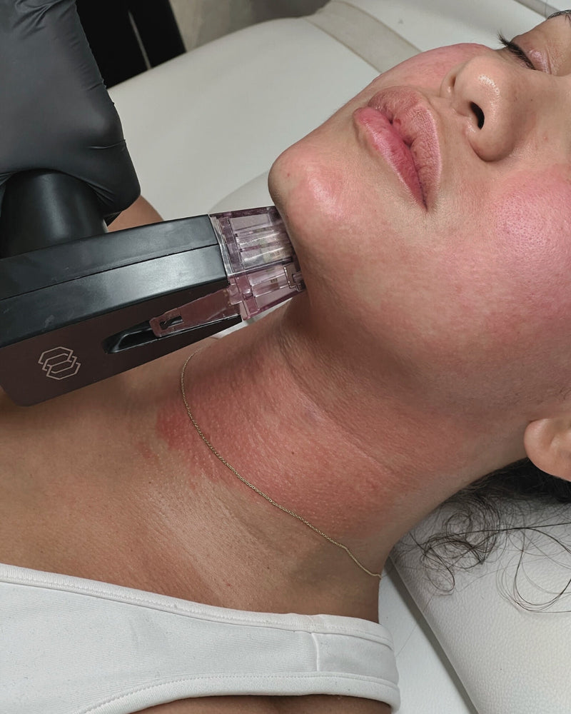 5 Reasons to Start Offering Morpheus8 In Your Med Spa