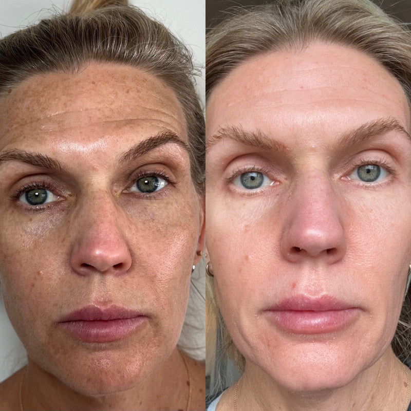 Melasma vs. Sun Damage: Why They’re Not the Same (and How to Treat It Right)