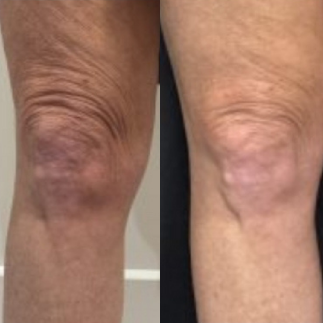 Sofwave™ Non-Invasive Skin Tightening