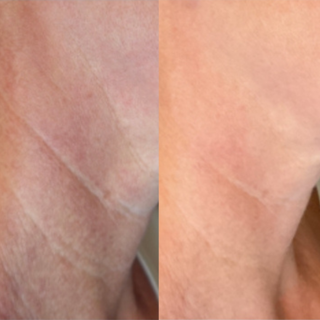 Sofwave™ Non-Invasive Skin Tightening