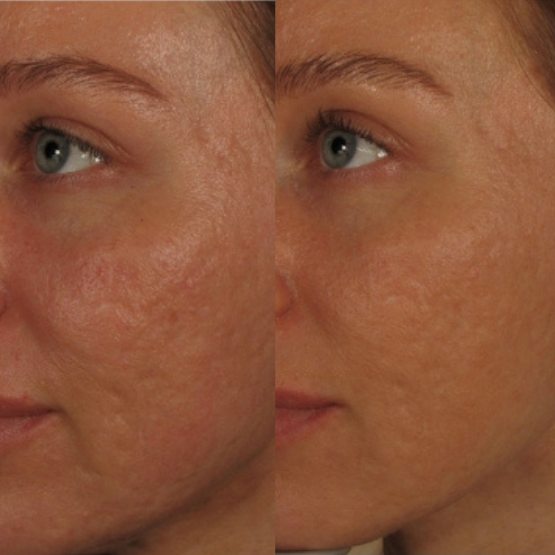 Sofwave™ Non-Invasive Skin Tightening