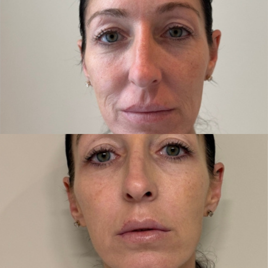 Sofwave™ Non-Invasive Skin Tightening