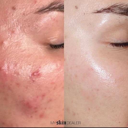 biorepeel-before-and-after.jpg
