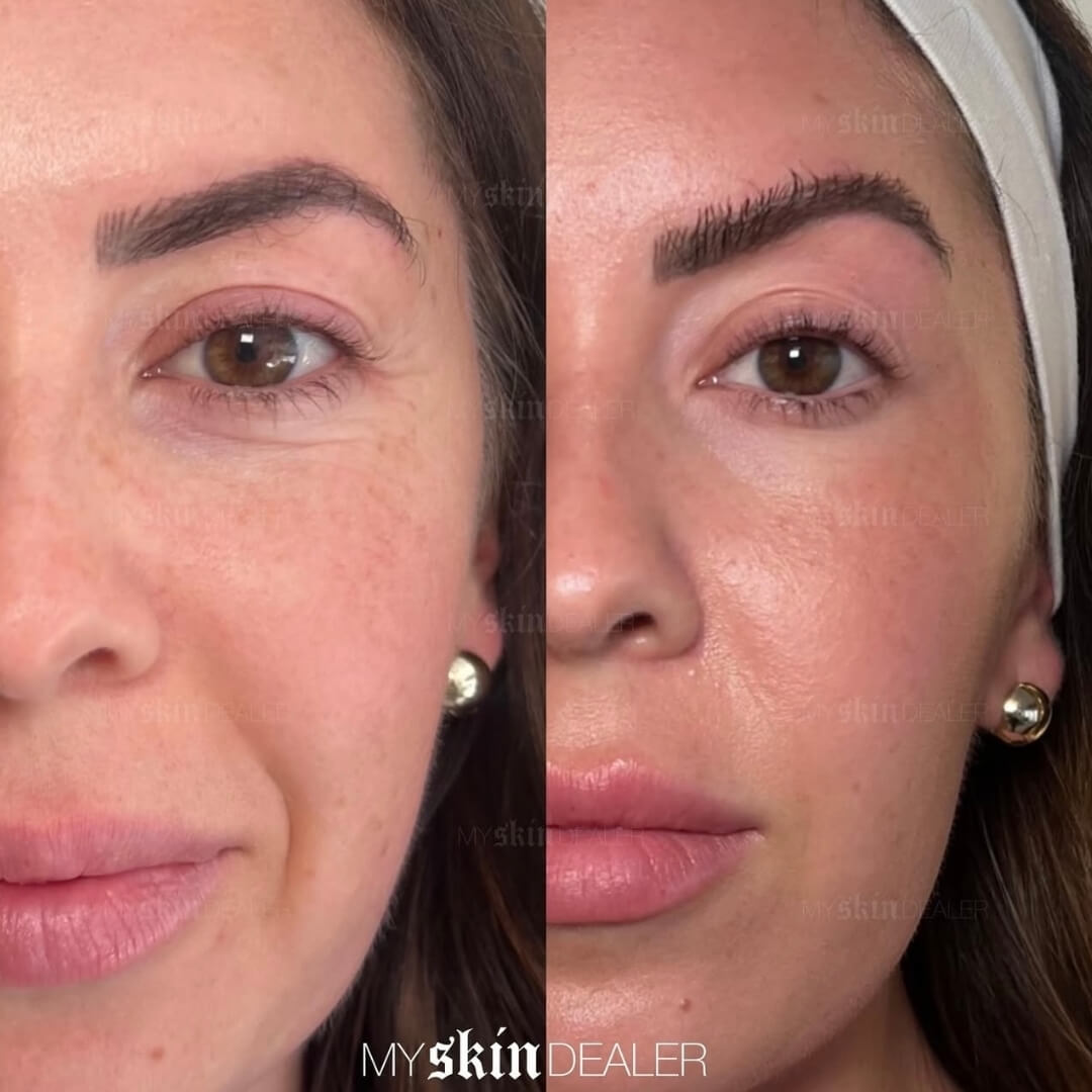 CoolPeel