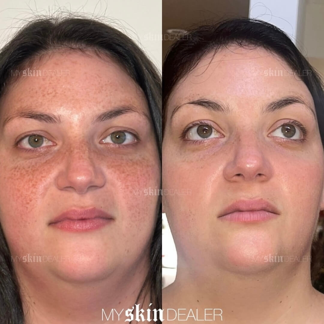 CoolPeel