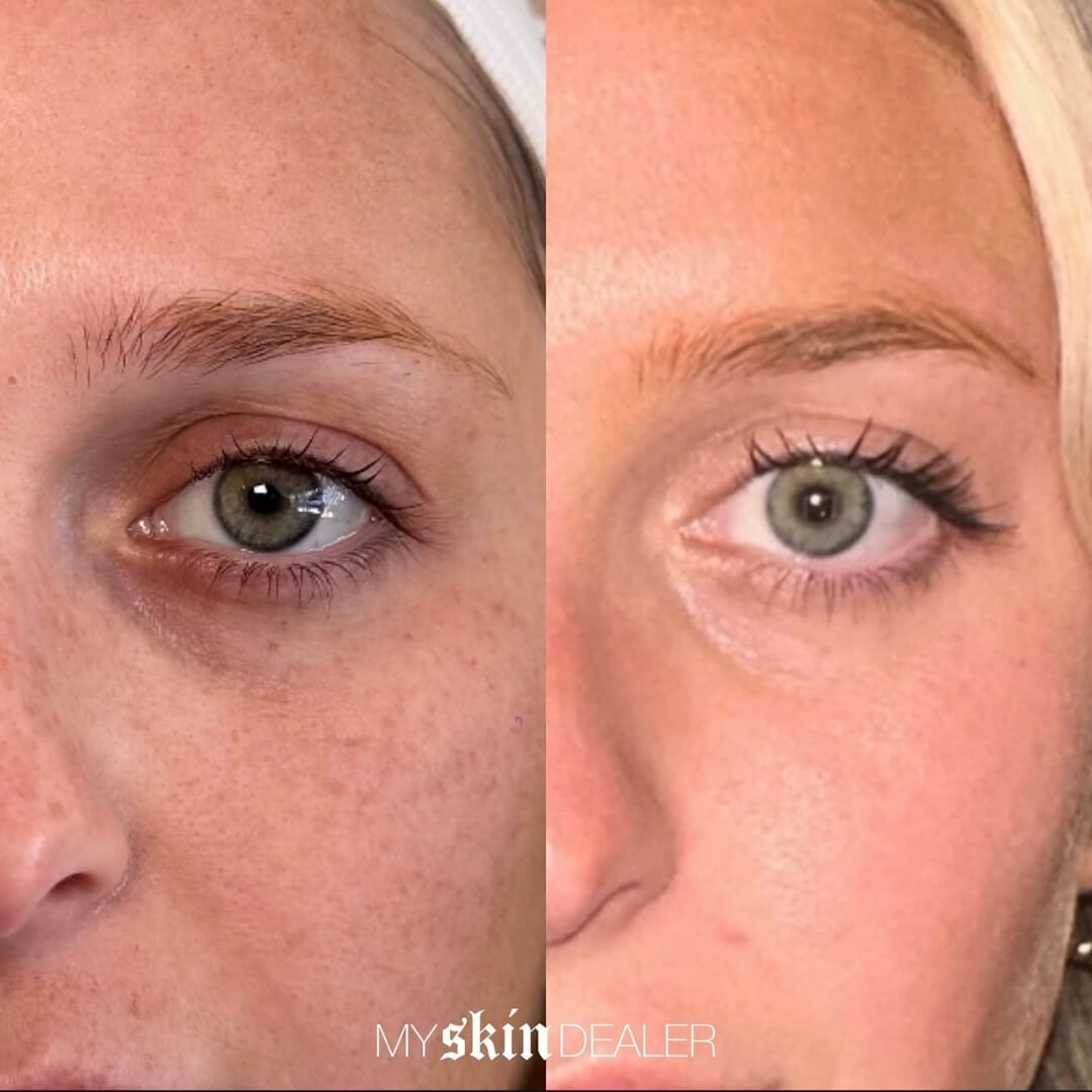 CoolPeel