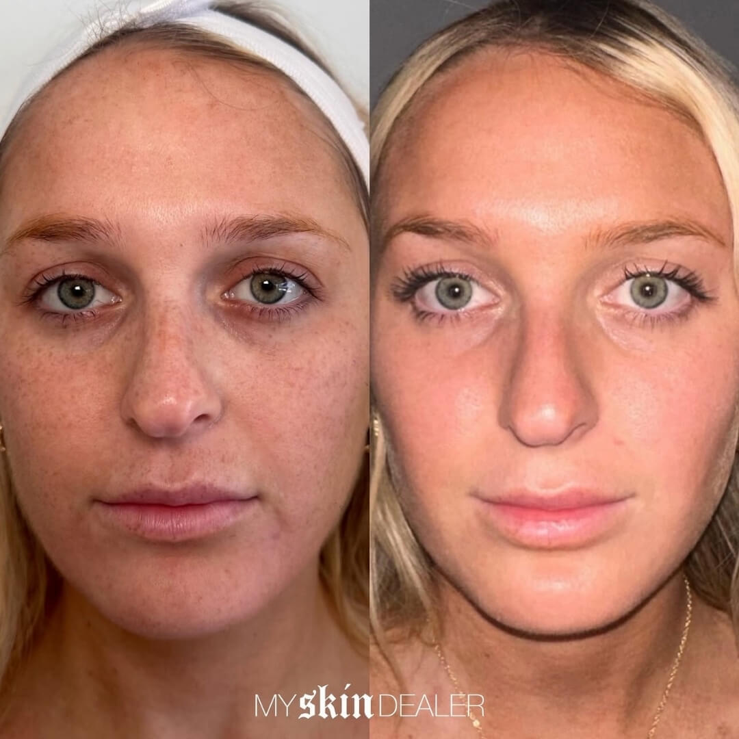 CoolPeel