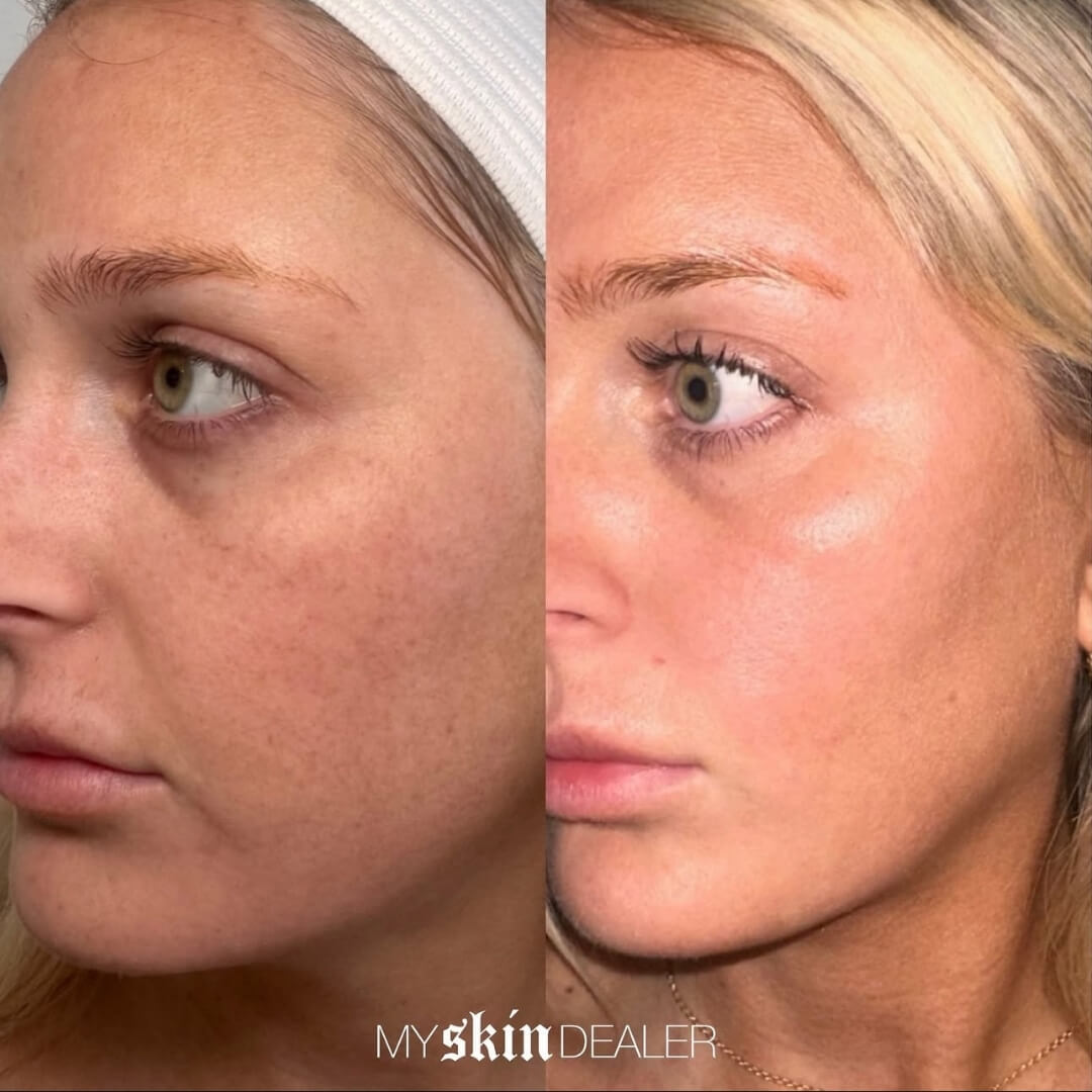 CoolPeel