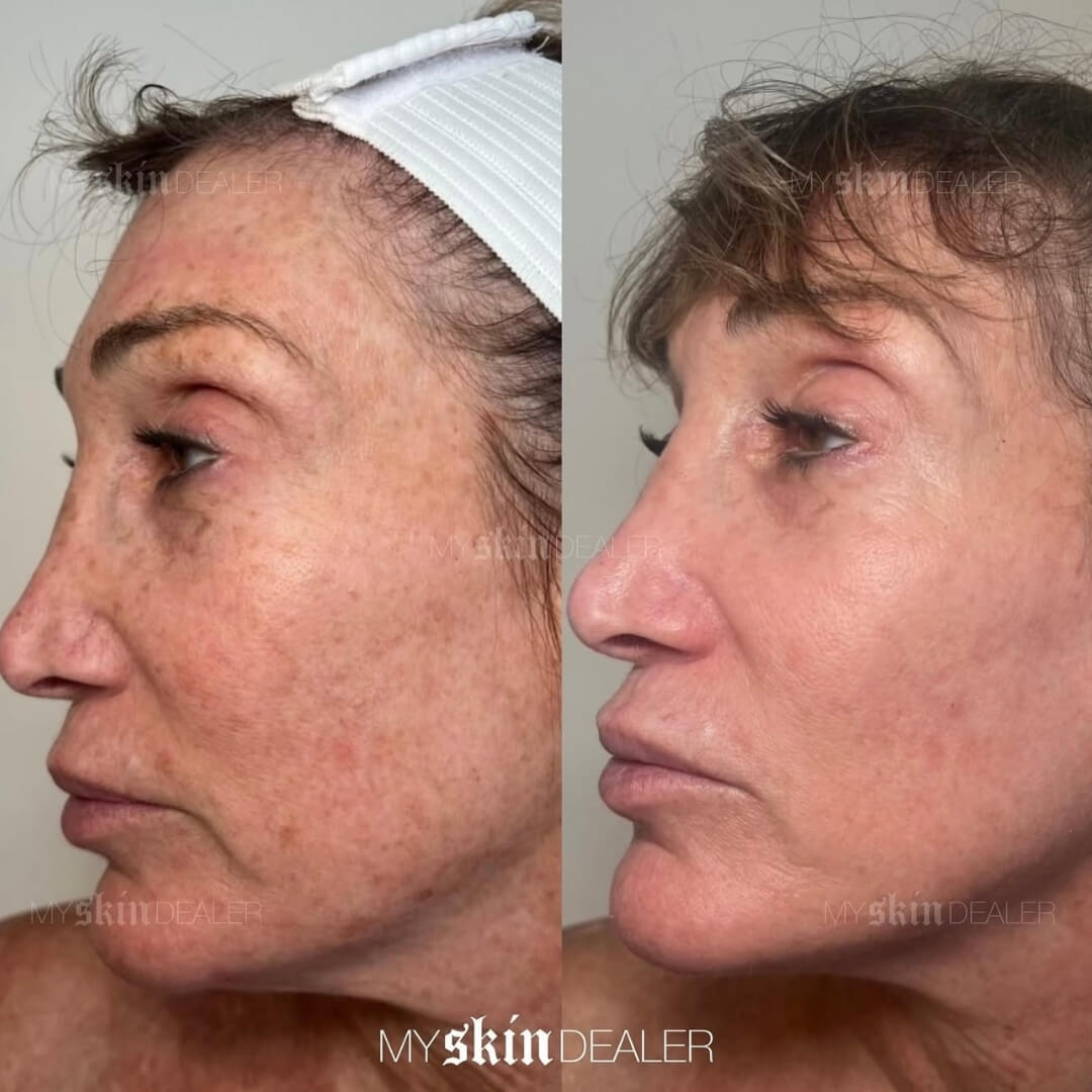 CoolPeel