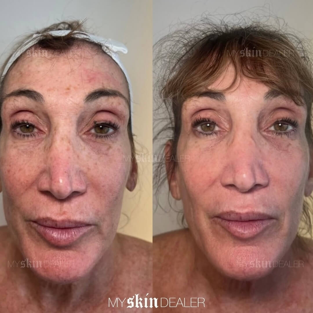 CoolPeel