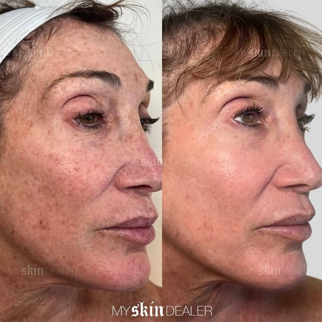 CoolPeel