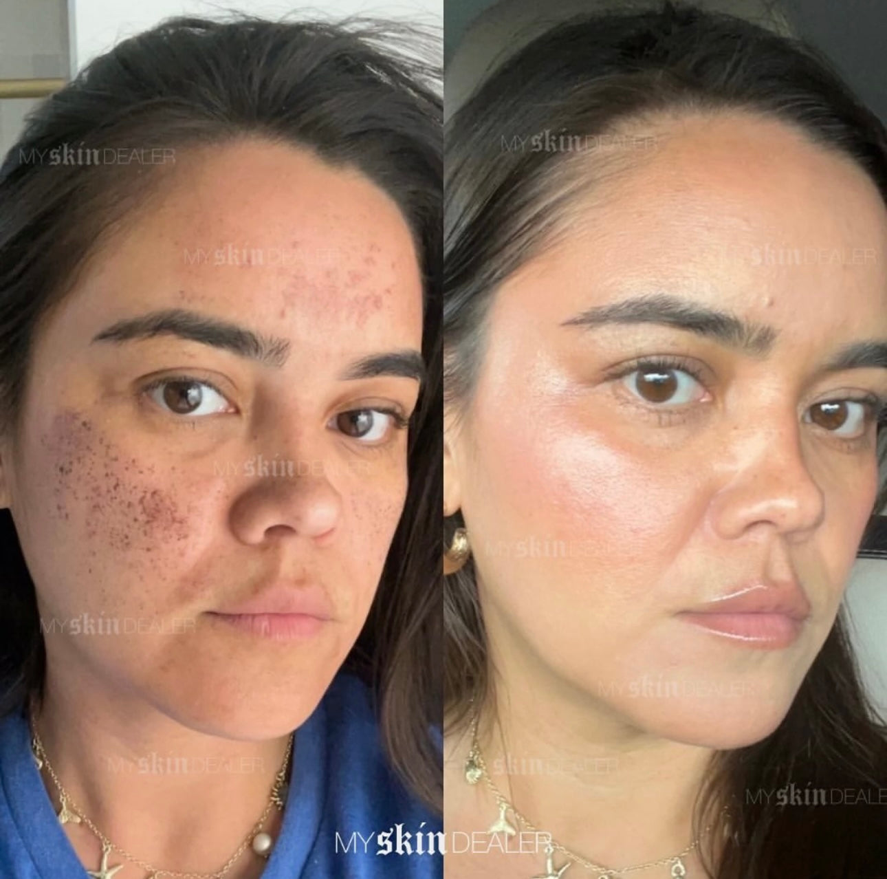 lumecca ipl, clear & brilliant(1).jpeg