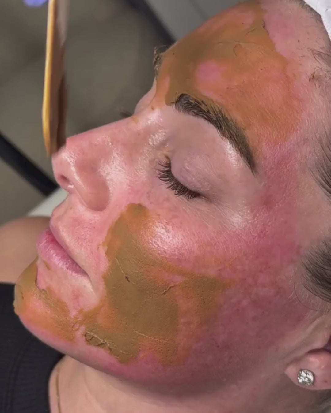 Cosmelan® Peel