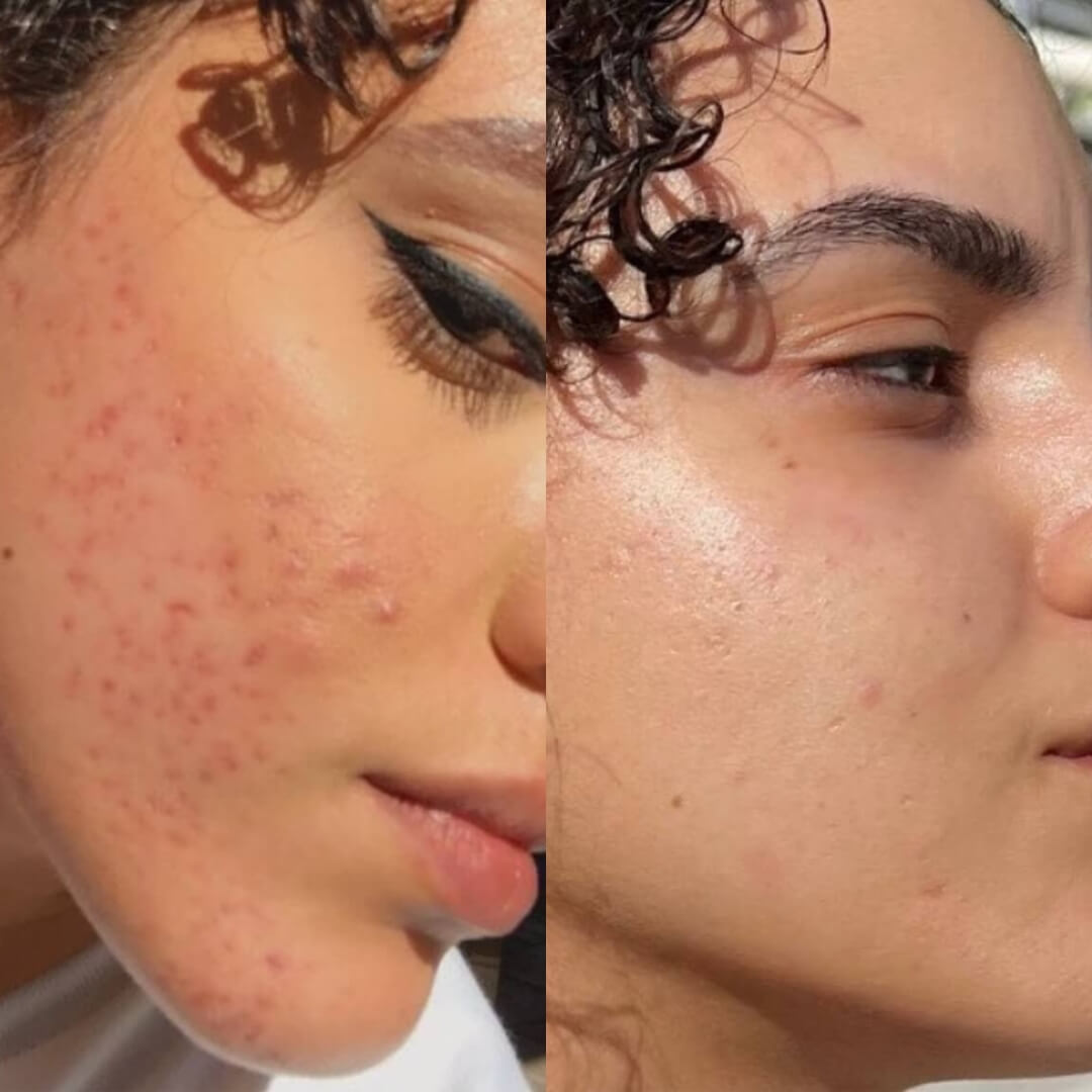 SkinPen® Microneedling